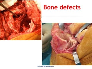 POSTGRAD ORTH Deiary Kader
Bone defects
 