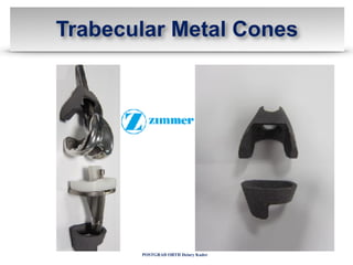POSTGRAD ORTH Deiary Kader
Trabecular Metal Cones
 
