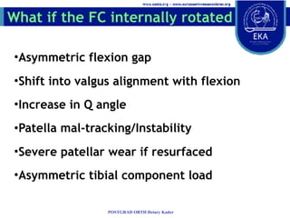 What if the FC internally rotated
•Asymmetric flexion gap
•Shift into valgus alignment with flexion
•Increase in Q angle
•...