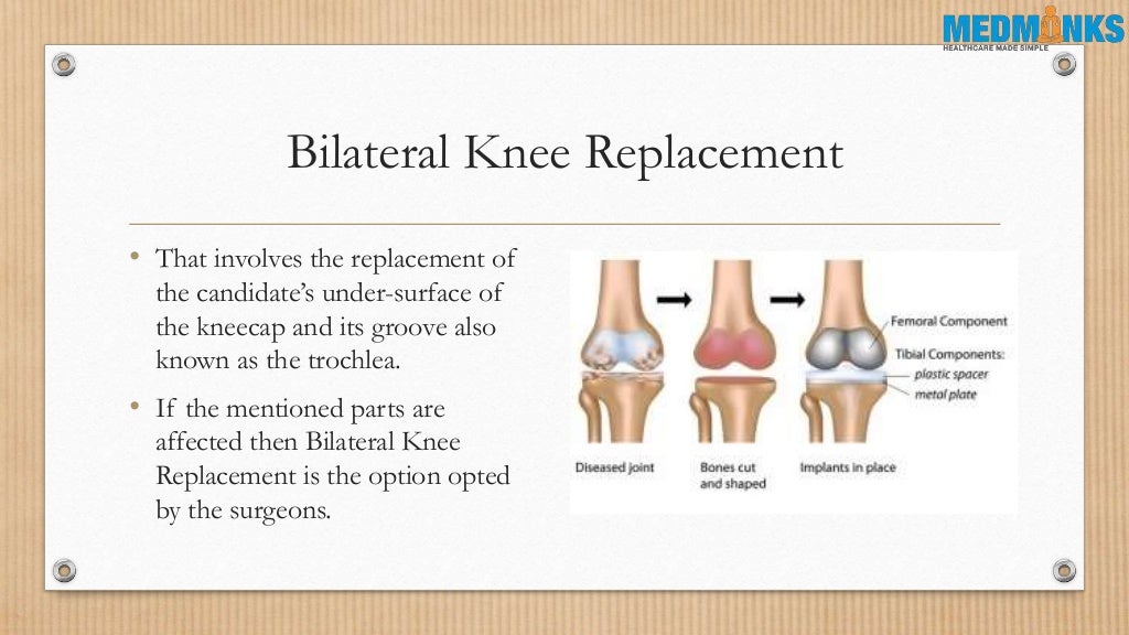 What Is Knee Replacement Surgery MedMonks