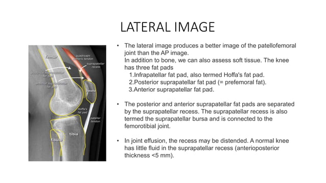 X Ray and MRI of Knee Joint | PPTX | Death, Injury, or Military ...
