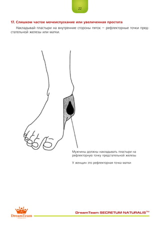 22
DreamTeam SECRETUM NATURALIS™
17. Слишком частое мочеиспускание или увеличенная простата
Накладывай пластыри на внутренние стороны пяток – рефлекторные точки пред-
стательной железы или матки.
Мужчины должны накладывать пластыри на
рефлекторную точку предстательной железы
У женщин это рефлекторная точка матки
 