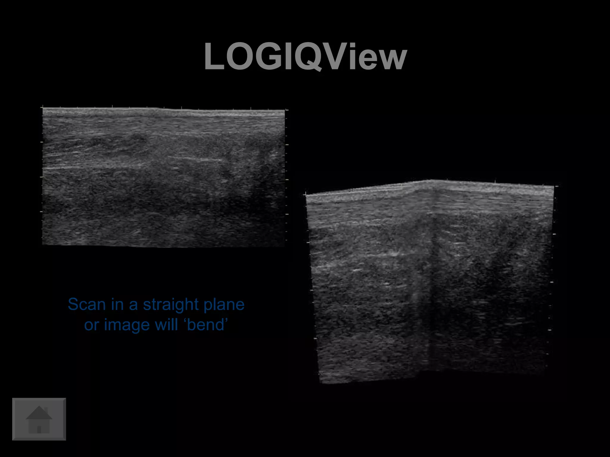 LOGIQView Scan in a straight plane or image will ‘bend’ 