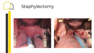 Staphylectomy
 
