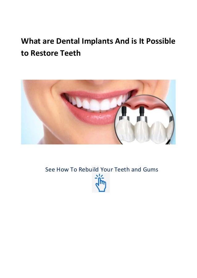 How to know what to expect when getting a tooth implant