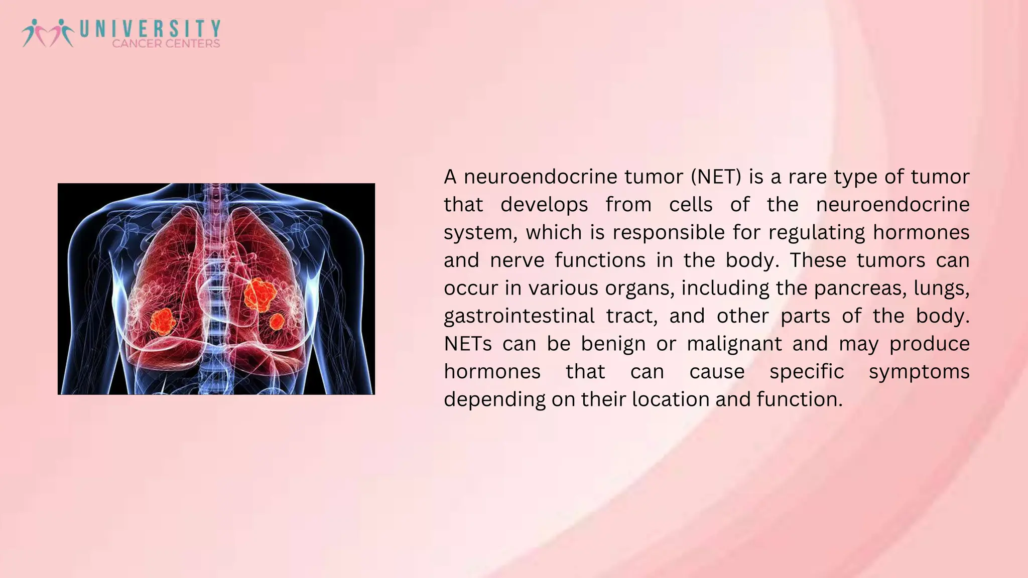 Know About Neuroendocrine Tumor - University Cancer Centers | PPT