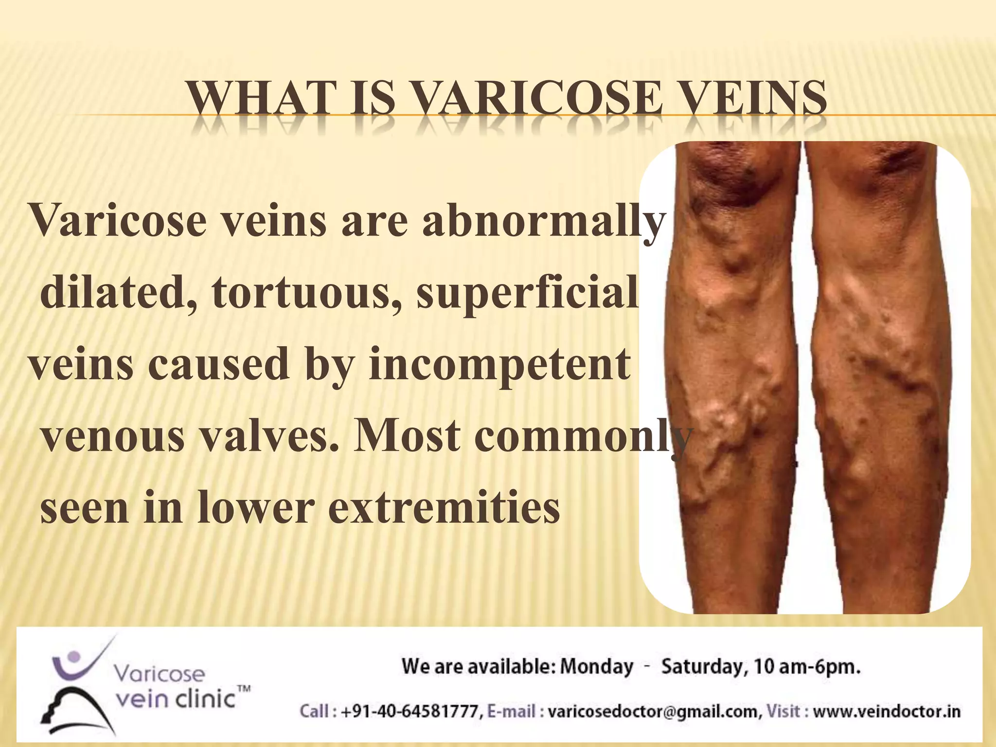 Know about varicose veins | Best Treatment for Varicose Veins | PPT