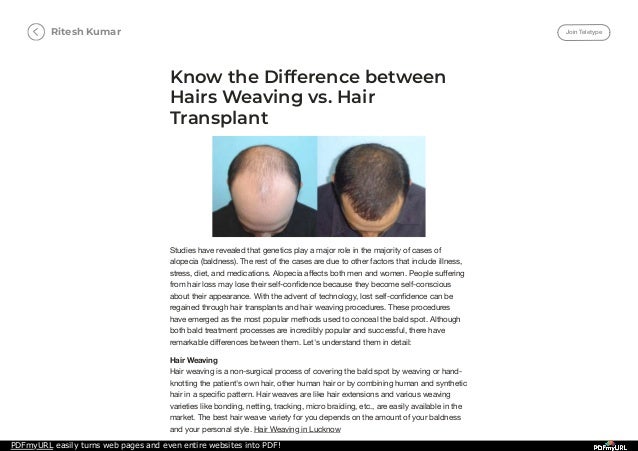 Know The Difference Between Hairs Weaving Vs Hair Transplant