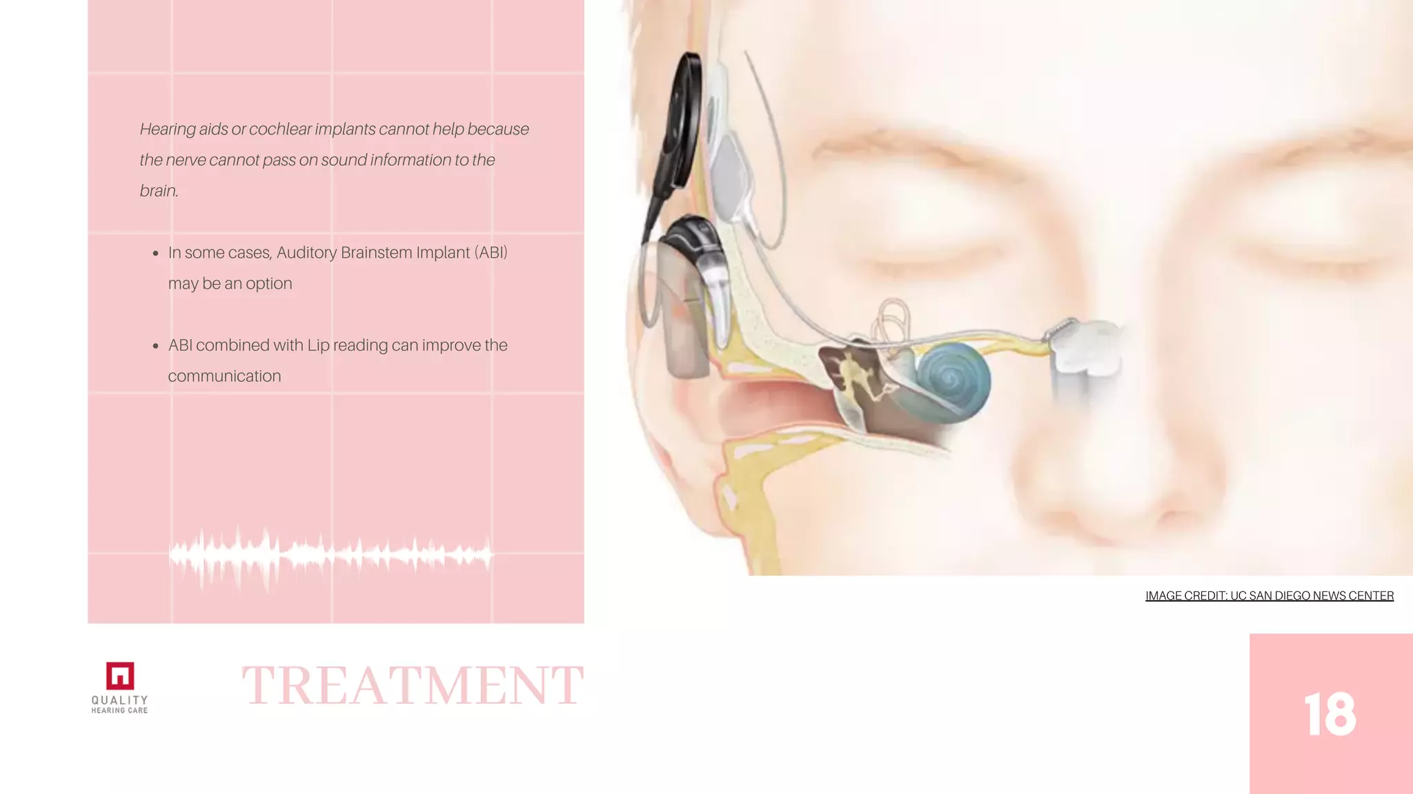 Different types of hearing loss degrees, and solutions. PDF