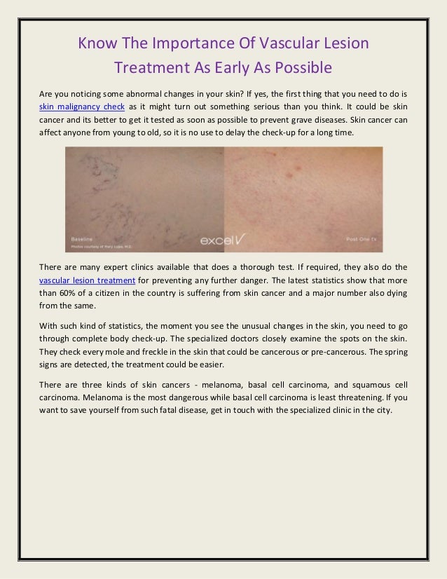 Know the importance of vascular lesion treatment as early as possible