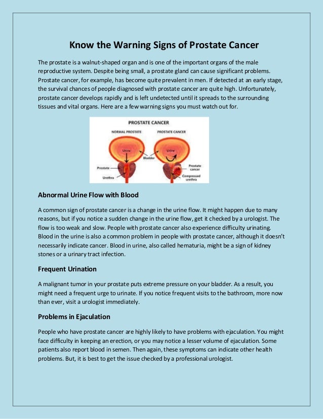 Know the Warning Signs of Prostate Cancer