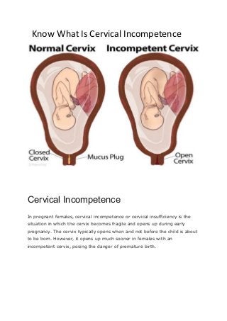 Know What Is Cervical Incompetence
Cervical Incompetence
In pregnant females, cervical incompetence or cervical insufficiency is the
situation in which the cervix becomes fragile and opens up during early
pregnancy. The cervix typically opens when and not before the child is about
to be born. However, it opens up much sooner in females with an
incompetent cervix, posing the danger of premature birth.
 