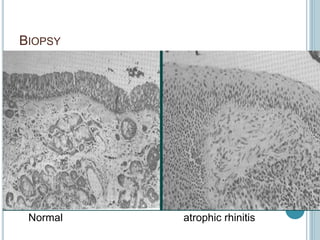 BIOPSY
Normal atrophic rhinitis
 