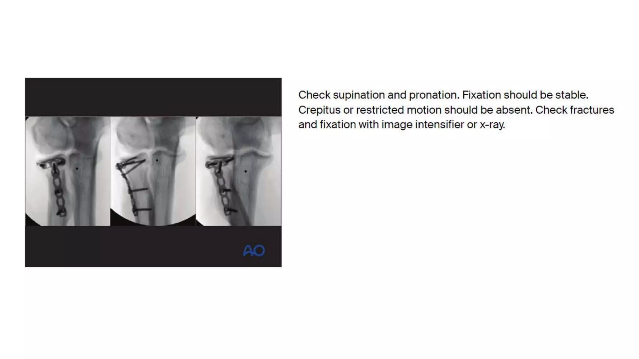 Kocher Approach for Radial Head Fracture.pptx