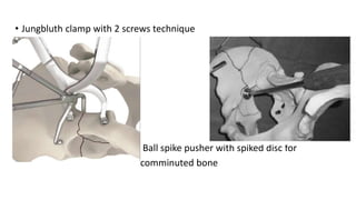 • Jungbluth clamp with 2 screws technique
Ball spike pusher with spiked disc for
comminuted bone
 