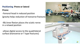 Positioning :Prone or lateral
Prone:
-Femoral head in reduced position
(gravity helps reduction of transerve fracture)
-90o knee flexion places the sciatic nerve
in a relaxed position
-allows digital access to the quadrilateral
surface (transverse or T type fractures)
 