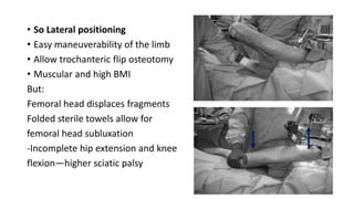 • So Lateral positioning
• Easy maneuverability of the limb
• Allow trochanteric flip osteotomy
• Muscular and high BMI
But:
Femoral head displaces fragments
Folded sterile towels allow for
femoral head subluxation
-Incomplete hip extension and knee
flexion—higher sciatic palsy
 