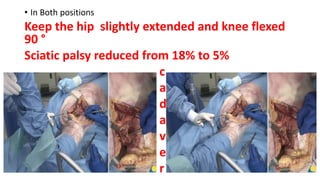 • In Both positions
Keep the hip slightly extended and knee flexed
90 °
Sciatic palsy reduced from 18% to 5%
c
a
d
a
v
e
r
 