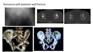 Transverse with posterior wall fracture
 