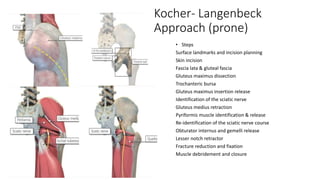 Kocher- Langenbeck
Approach (prone)
• Steps
Surface landmarks and incision planning
Skin incision
Fascia lata & gluteal fascia
Gluteus maximus dissection
Trochanteric bursa
Gluteus maximus insertion release
Identification of the sciatic nerve
Gluteus medius retraction
Pyriformis muscle identification & release
Re-identification of the sciatic nerve course
Obturator internus and gemelli release
Lesser notch retractor
Fracture reduction and fixation
Muscle debridement and closure
 
