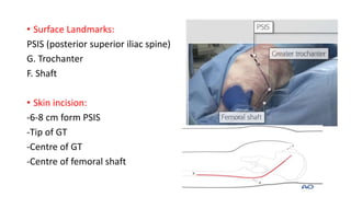 • Surface Landmarks:
PSIS (posterior superior iliac spine)
G. Trochanter
F. Shaft
• Skin incision:
-6-8 cm form PSIS
-Tip of GT
-Centre of GT
-Centre of femoral shaft
 