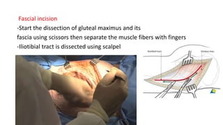 Fascial incision
-Start the dissection of gluteal maximus and its
fascia using scissors then separate the muscle fibers with fingers
-Iliotibial tract is dissected using scalpel
 