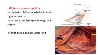• Gluteus maximum splitting
• - posterior 2/3 muscle belly (inferior
• gluteal artery),
• - anterior 1/3 belly (superior gluteal
Artery
Inferior gluteal bundle is the limit
 