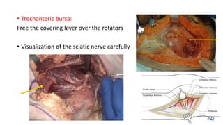 • Trochanteric bursa:
Free the covering layer over the rotators
• Visualization of the sciatic nerve carefully
 