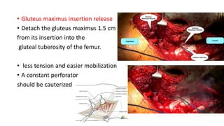 • Gluteus maximus insertion release
• Detach the gluteus maximus 1.5 cm
from its insertion into the
gluteal tuberosity of the femur.
• less tension and easier mobilization
• A constant perforator
should be cauterized
 