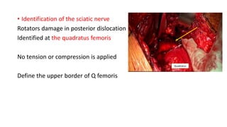 • Identification of the sciatic nerve
Rotators damage in posterior dislocation
Identified at the quadratus femoris
No tension or compression is applied
Define the upper border of Q femoris
Quadratus
 