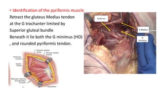 • Identification of the pyriformis muscle
Retract the gluteus Medius tendon
at the G trochanter limited by
Superior gluteal bundle
Beneath it lie both the G minimus (HO)
, and rounded pyriformis tendon.
G Medius
G
minimus
Pyriformis
 