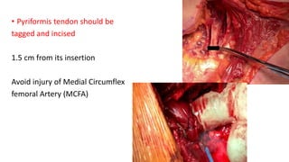 • Pyriformis tendon should be
tagged and incised
1.5 cm from its insertion
Avoid injury of Medial Circumflex
femoral Artery (MCFA)
 