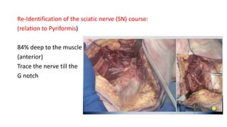 Re-Identification of the sciatic nerve (SN) course:
(relation to Pyriformis)
84% deep to the muscle
(anterior)
Trace the nerve till the
G notch
 