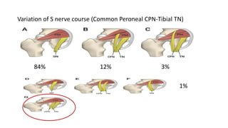 Variation of S nerve course (Common Peroneal CPN-Tibial TN)
84% 12% 3%
1%
 