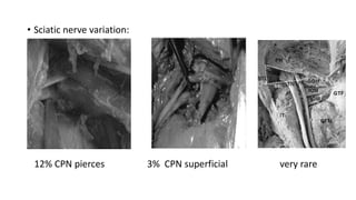 • Sciatic nerve variation:
12% CPN pierces 3% CPN superficial very rare
 