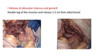 • Release of obturator internus and gemelli:
Double tag of the muscles and release 1.5 cm form attachment
 
