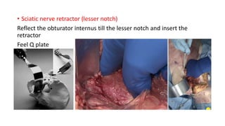 • Sciatic nerve retractor (lesser notch)
Reflect the obturator internus till the lesser notch and insert the
retractor
Feel Q plate
 