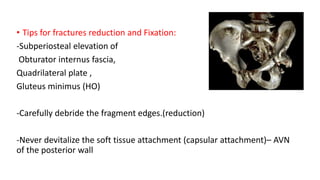 • Tips for fractures reduction and Fixation:
-Subperiosteal elevation of
Obturator internus fascia,
Quadrilateral plate ,
Gluteus minimus (HO)
-Carefully debride the fragment edges.(reduction)
-Never devitalize the soft tissue attachment (capsular attachment)– AVN
of the posterior wall
 