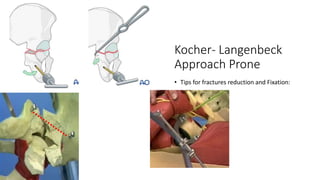 Kocher- Langenbeck
Approach Prone
• Tips for fractures reduction and Fixation:
 