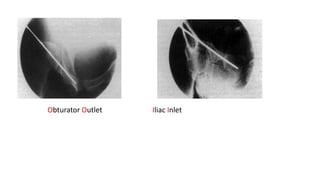 Obturator Outlet Iliac Inlet
 