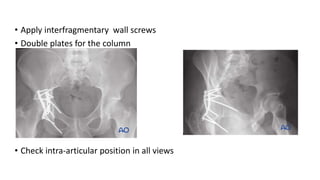 • Apply interfragmentary wall screws
• Double plates for the column
• Check intra-articular position in all views
 