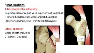 • Modifications:
1-Trochanteric flip osteotomy:
-Supraacetabular region with superior wall fragment
-Femoral head fracture with surgical dislocation
-Anterior column screw –transtectal transverse
Lateral approach
Single sheath including
V lateralis, G Medius
1.5 cm
 