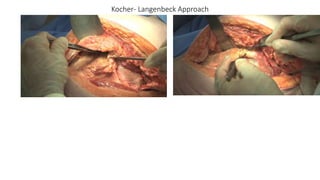 Kocher- Langenbeck Approach
 