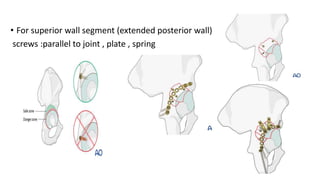 • For superior wall segment (extended posterior wall)
screws :parallel to joint , plate , spring
 