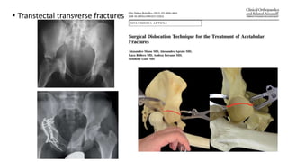 • Transtectal transverse fractures
 