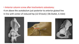 • Anterior column screw after trochanteric osteotomy:
4 cm above the acetabulum just posterior to anterior gluteal line
In line with center of reduced hip (12 O’clock) ( Ob Outlet, IL Inlet)
 