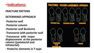 •Indications:
FRACTURE PATTERN
DETERMINES APPROACH
-Posterior wall
-Posterior column
-Posterior wall &column
-Transverse with posterior wall
-Transverse with major
displacement at the posterior
column (juxtatectal and
infratectal).
- Posterior elements in T-type
 