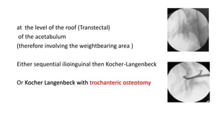 at the level of the roof (Transtectal)
of the acetabulum
(therefore involving the weightbearing area )
Either sequential ilioinguinal then Kocher-Langenbeck
Or Kocher Langenbeck with trochanteric osteotomy
 