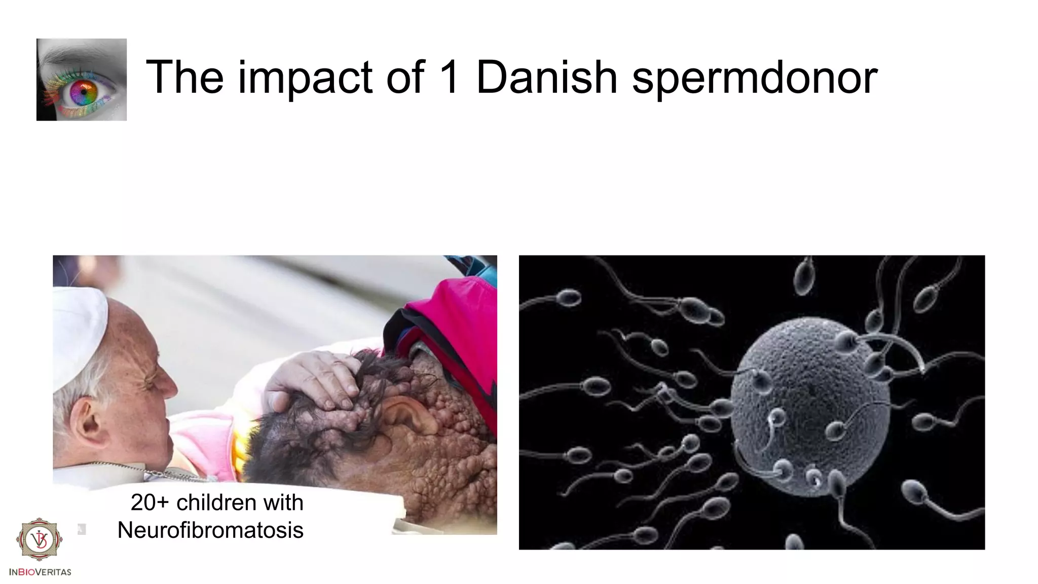 The impact of 1 Danish spermdonor

20+ children with
Neurofibromatosis

 