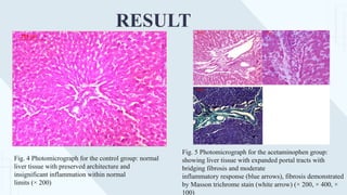 RESULT
Fig. 4 Photomicrograph for the control group: normal
liver tissue with preserved architecture and
insignificant inflammation within normal
limits (× 200)
Fig. 5 Photomicrograph for the acetaminophen group:
showing liver tissue with expanded portal tracts with
bridging fibrosis and moderate
inflammatory response (blue arrows), fibrosis demonstrated
by Masson trichrome stain (white arrow) (× 200, × 400, ×
100)
 